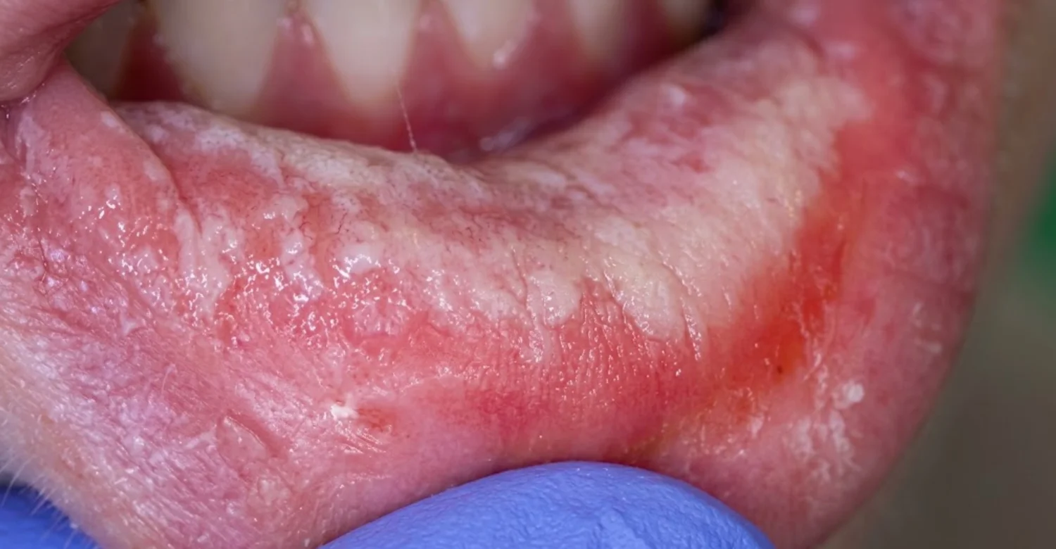 Toothpaste Induced Contact Stomatitis inblog